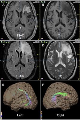 Noninvasive Prediction of Language Lateralization Through Arcuate Fasciculus Tractography in Patients With Low-Grade Gliomas: Correlation With The Wada Test